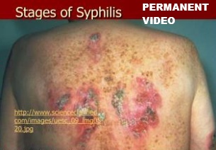 SYPHILIS